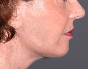 chin augmentation after photo patient